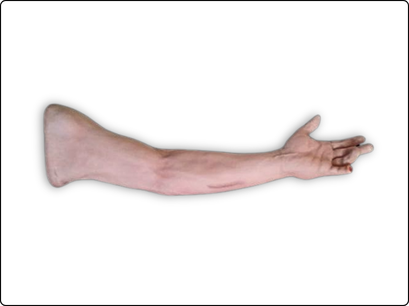 Scar Revision Arm