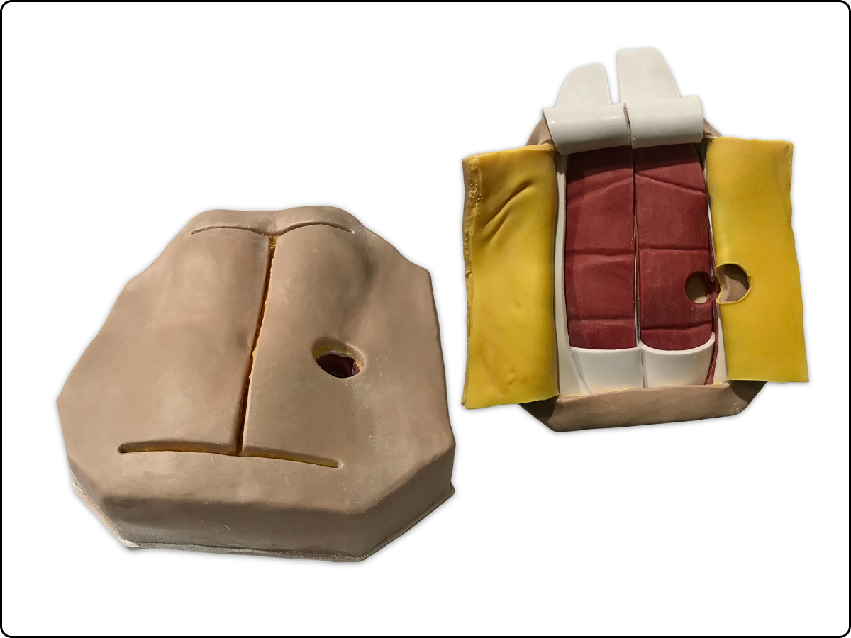 Abdominal Mesh Model image 1