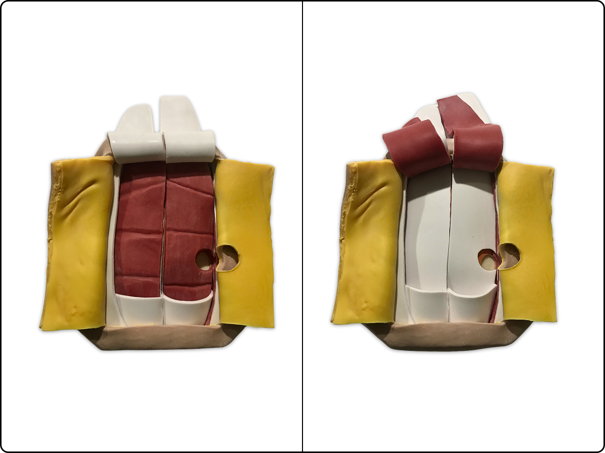 Abdominal Mesh Model image 2