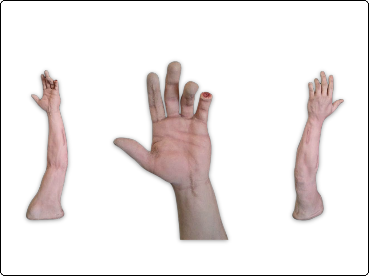 Scar Revision Arm image 1